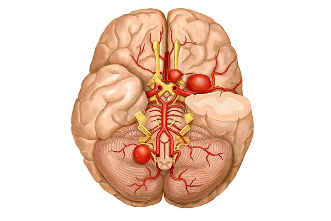 عمليات الأوعية الدماغية