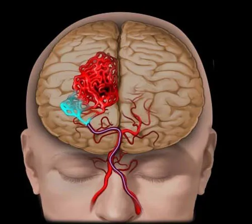 الأوعية الدموية الدماغية