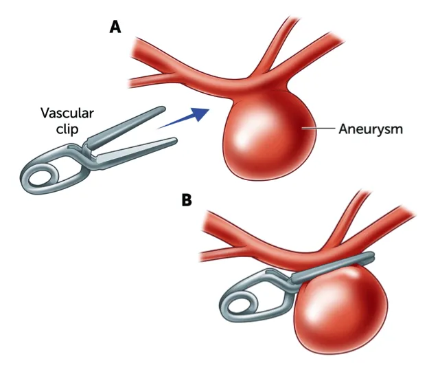 جراحة تمدد الأوعية الدموية